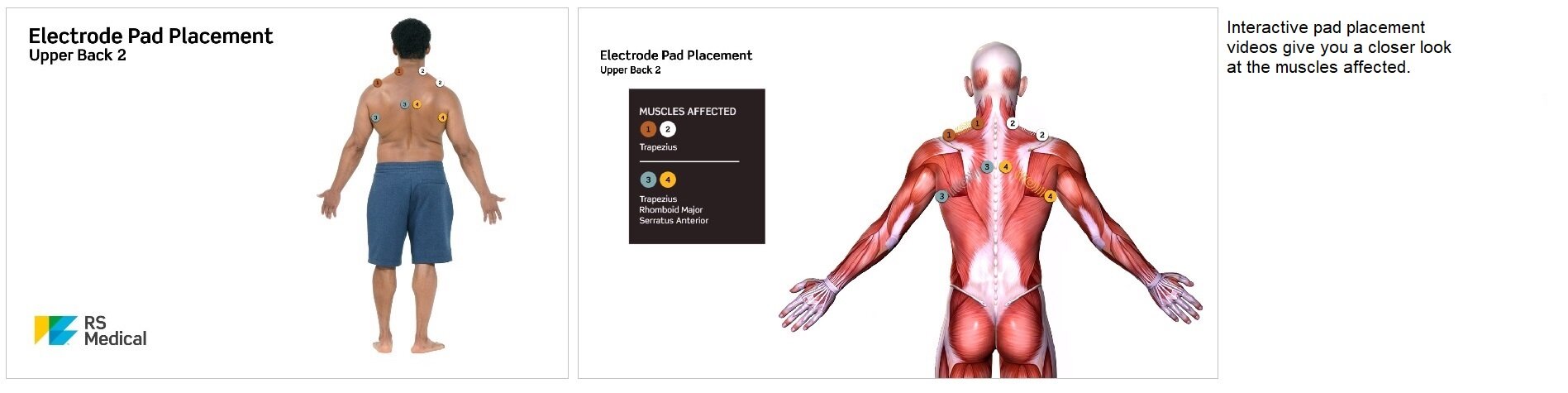RS Medical pad placement videos give you a closer look at the areas and muscles affected.