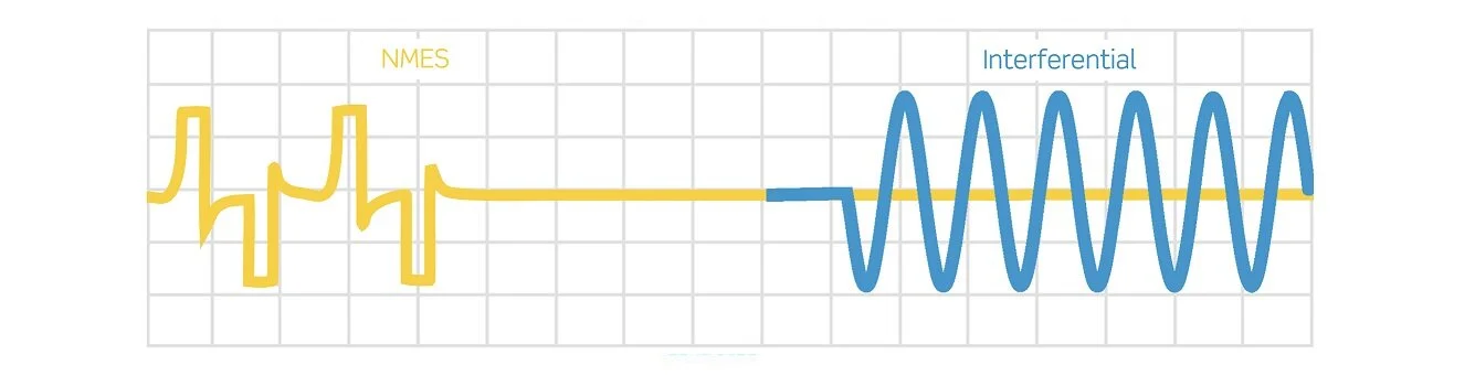 Intersperse delivers high-frequency (&gt;5000 Hz) INF pain relief signals to the patient during the relax period of a low-frequency (71 Hz) NMES treatment. In this way, the patient gets intermittent muscle contraction, then pain relief, then muscle …